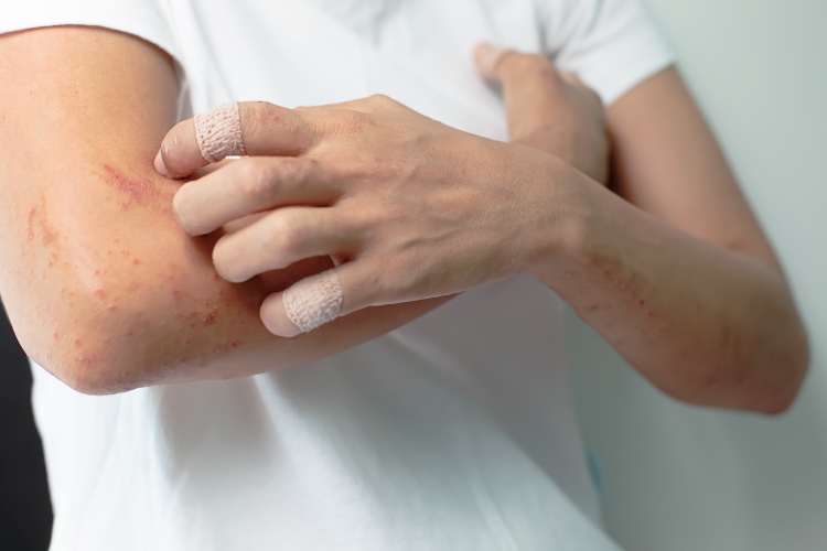Woman Scratching Rash